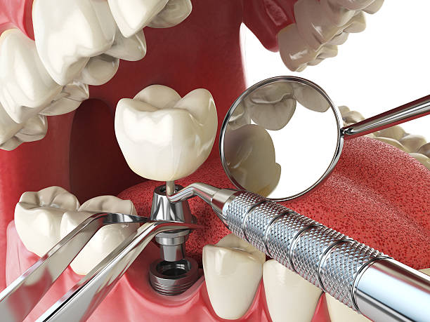 Best Emergency Denture Repair in Seat Pleasant, MD